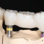 fogbeültetés Budaörs Dental