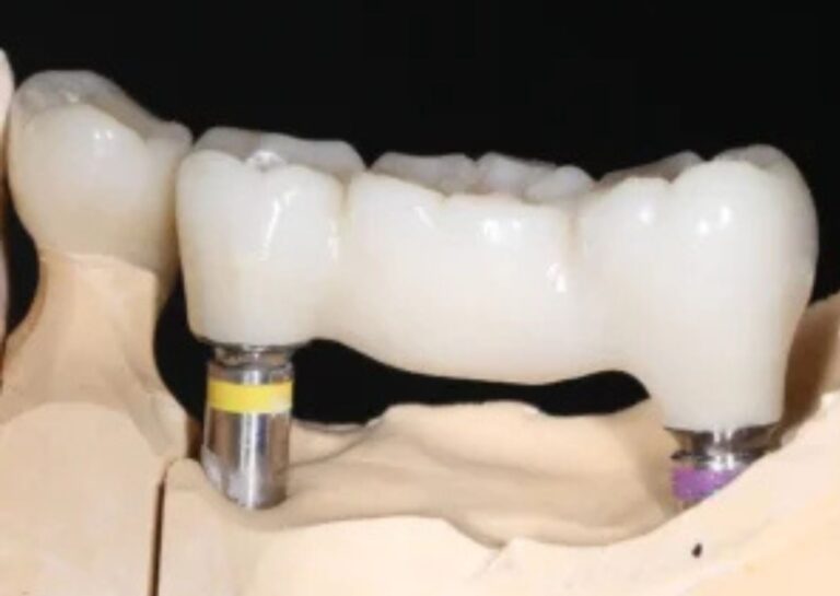 fogbeültetés Budaörs Dental