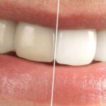 esztetikai-fogaszat Budaörs Dental