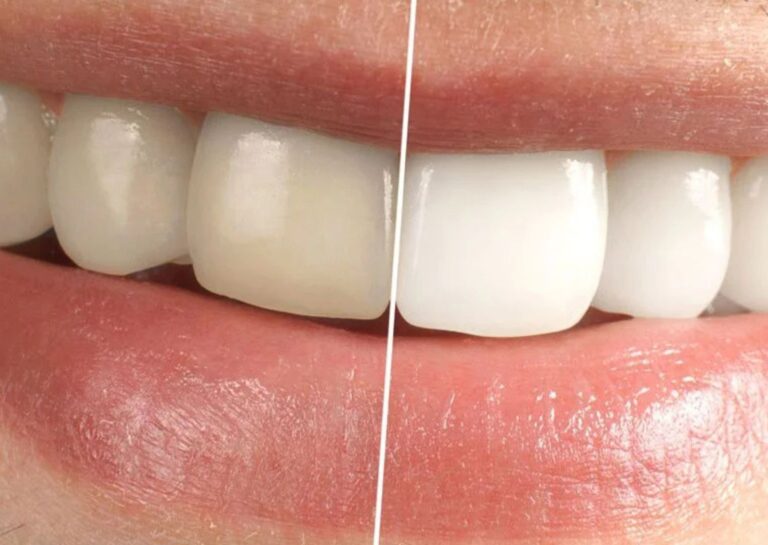 esztetikai-fogaszat Budaörs Dental