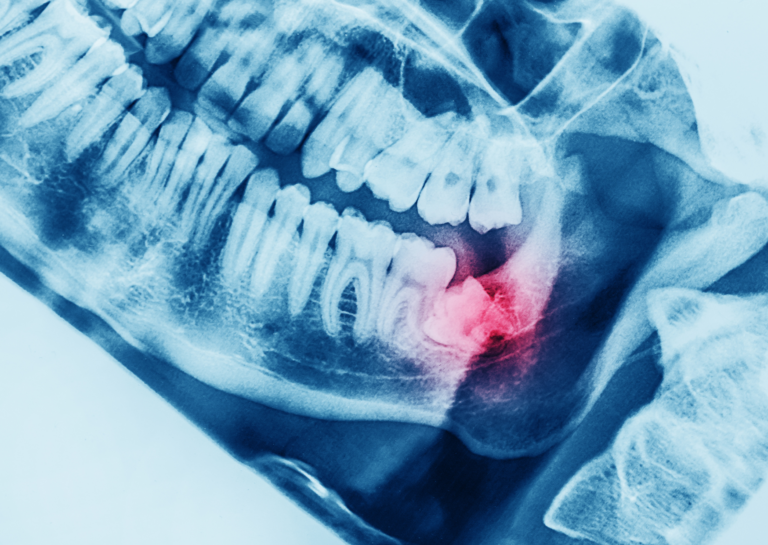 budaors-dental-cikk-bolcsessegfog
